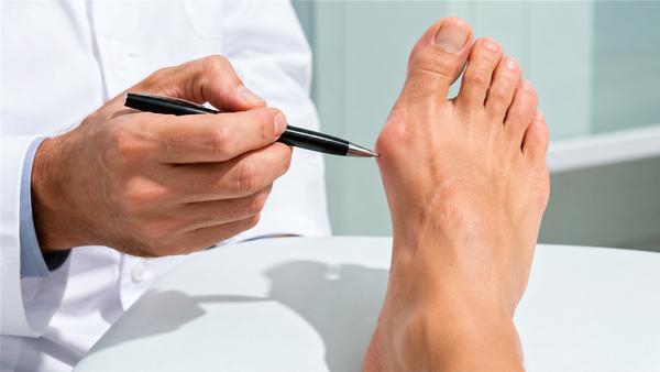 Minimally Invasive Bunion Surgery