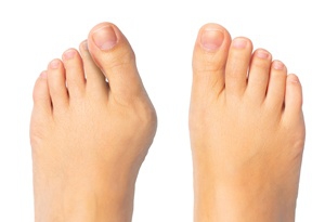 Minimally Invasive Bunion Surgery