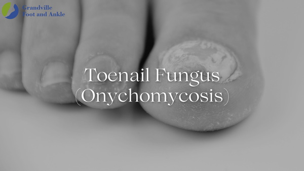 Toenail Fungus (also known as Onychomycosis)